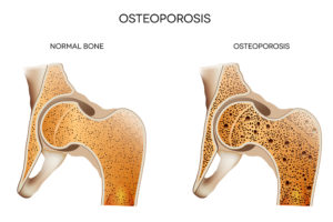 Diagnosing Osteoporosis and Warning Signs